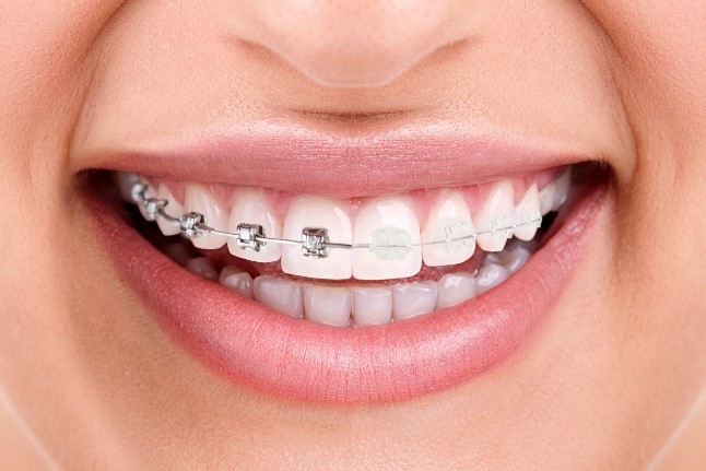 Aparelho autoligado Damon System