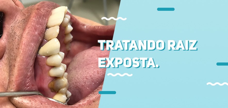 Retração Gengival: como tratar casos de raiz exposta