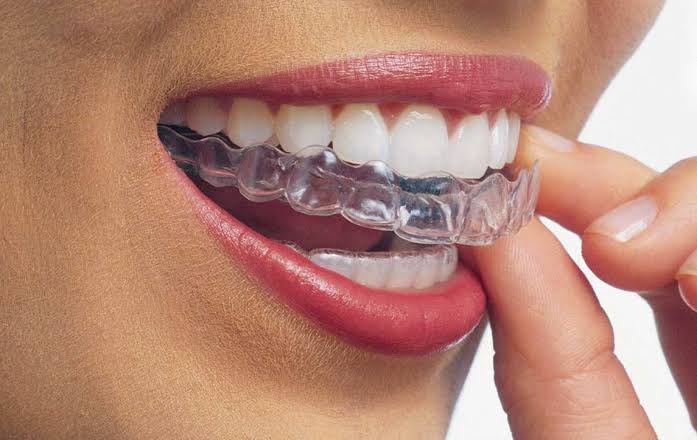 O que é o Invisalign? 