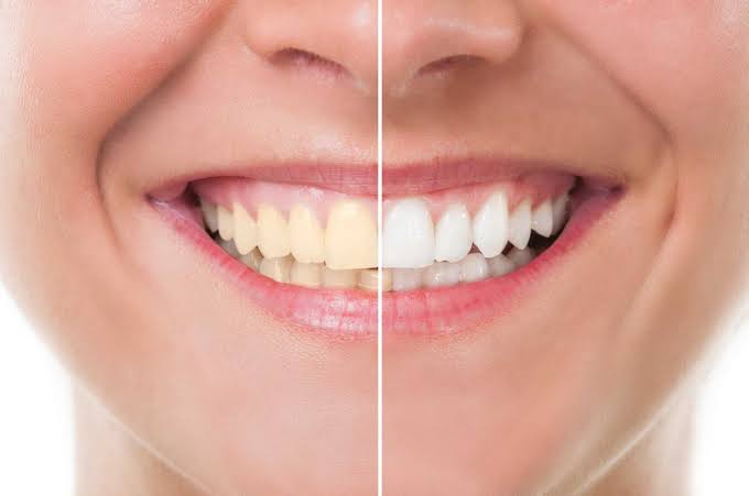 Cuidados após o clareamento dental