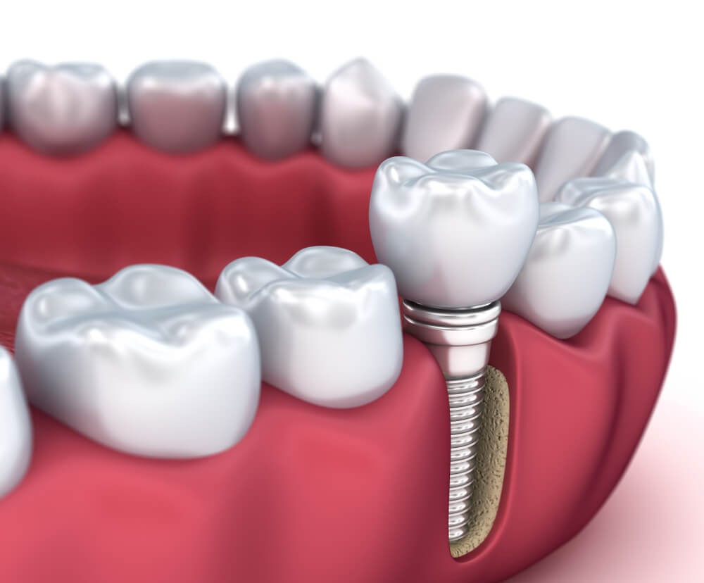 Implante Dentário